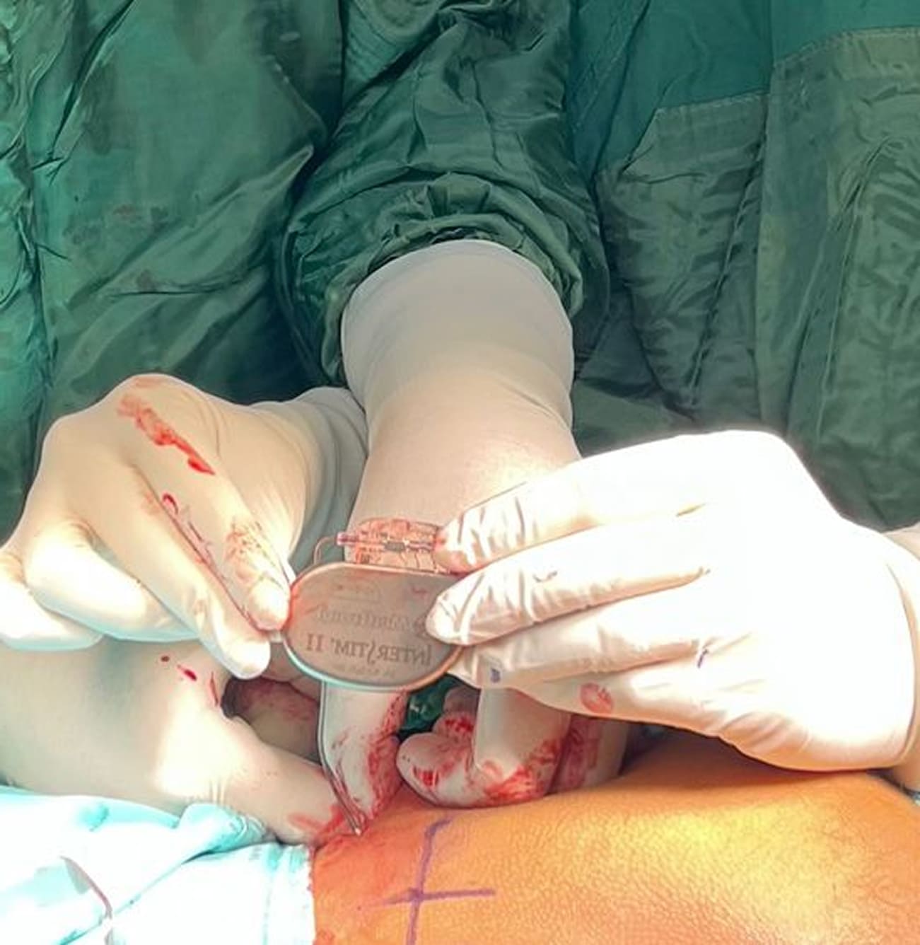 Gynecological surgery close-up sterile procedure